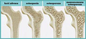 Co powoduje osteoporozę?